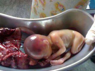 aborted-fetus